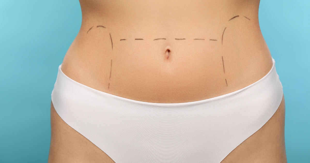 Body Feminization Surgery Cost