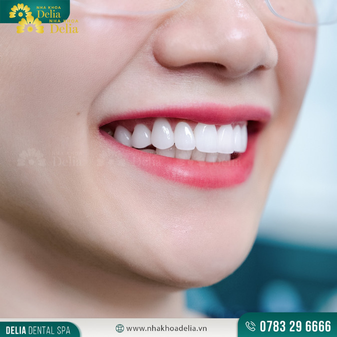Ưu điểm của phương pháp bắc cầu răng sứ: khôi phục thẩm mỹ cho nụ cười