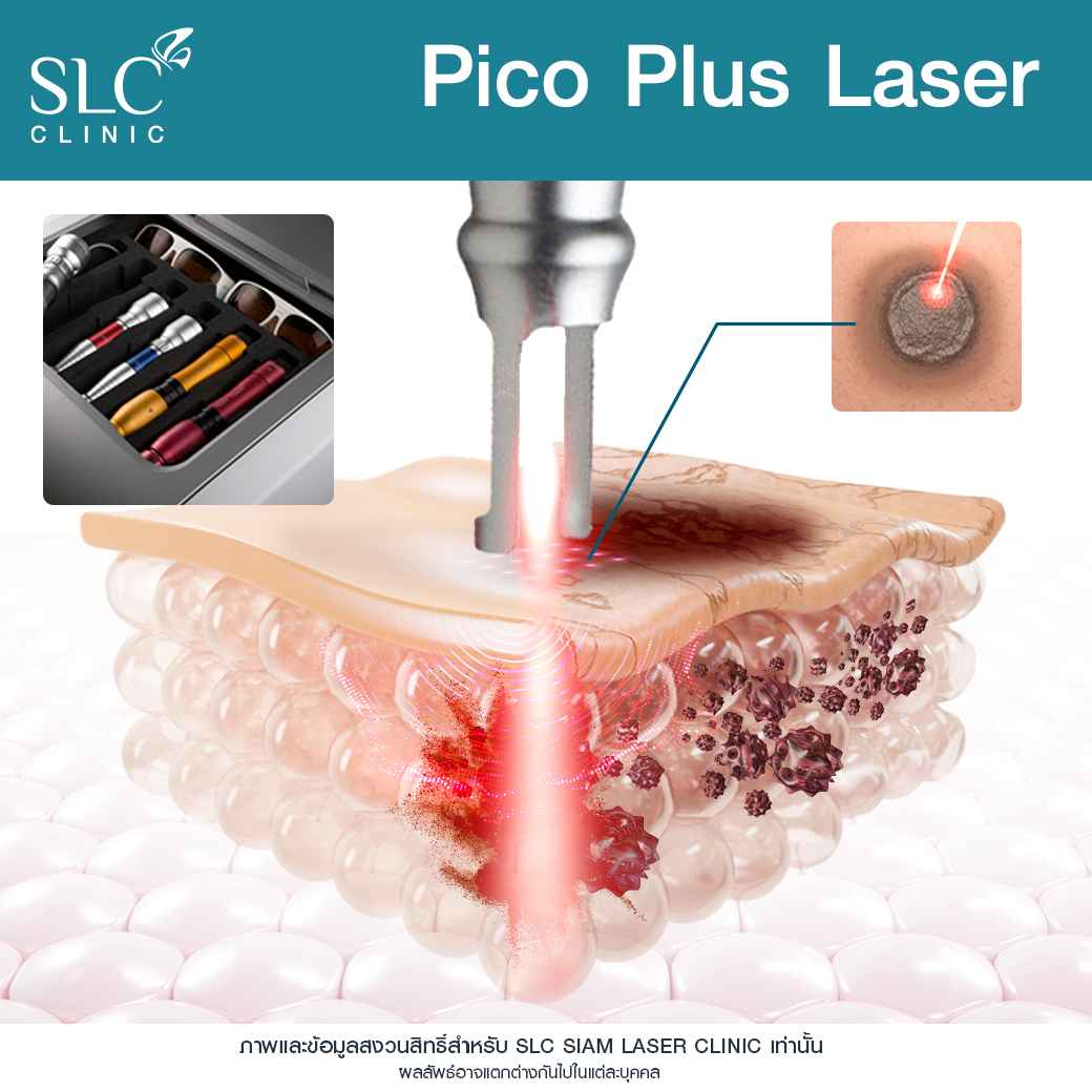 รักษาหลุมสิว, รอยสิว, Pico Plus Laser, Sylfirm X Plus