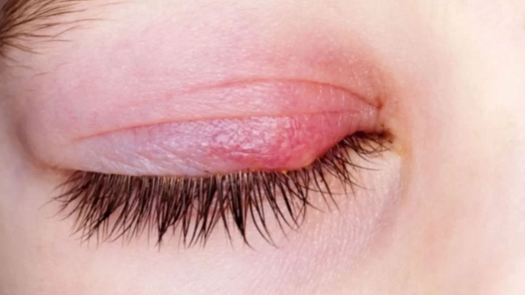 What is commonly misdiagnosed as pink eye