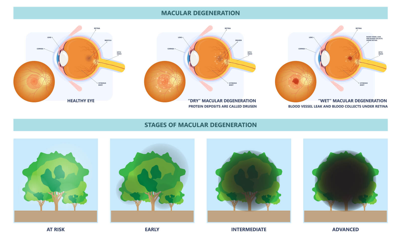 Image explaining macular degeneration. 