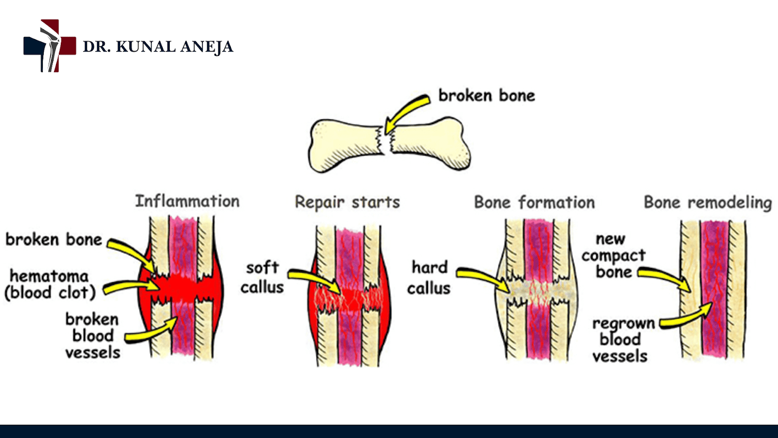 Bone Fracture Treatment in Delhi