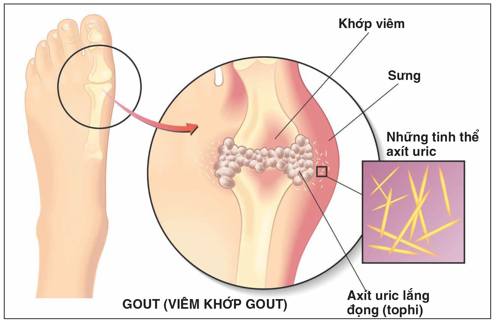 benh-gout-1