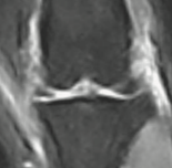 Obrázek 12: Zdravý kolenní kloub zobrazen pomocí MRI (2) 