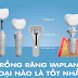 Nên trồng răng Implant loại nào? Trụ Implant tốt nhất