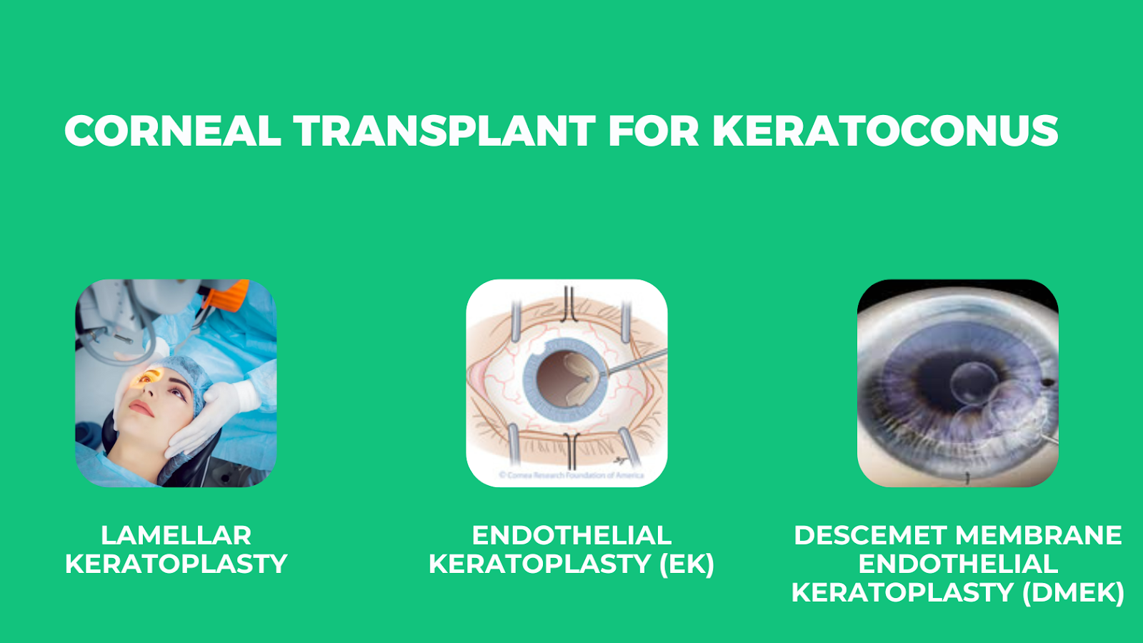 corneal-transplent-for-keratoconus