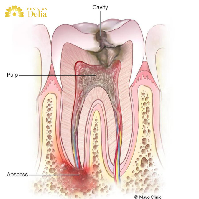 Nguyên nhân do áp xe răng 