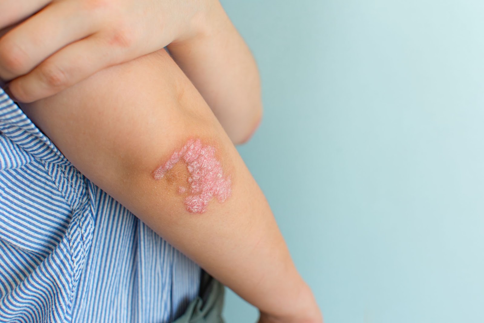 Impactul Psoriazisului asupra Calității Vieții Pacienților
