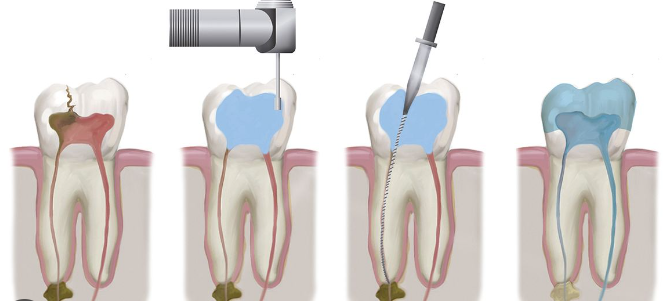 steps involved in a typical root canal