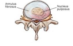 https://www.physio-pedia.com/images/thumb/a/a2/Annular-bulge-disc-rev.jpg/250px-Annular-bulge-disc-rev.jpg