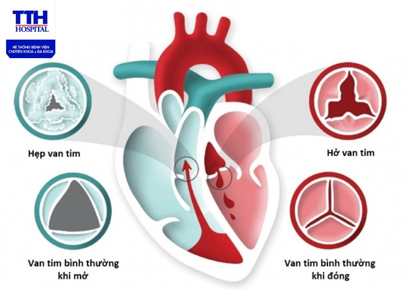 Triệu chứng và nguyên nhân bệnh van tim