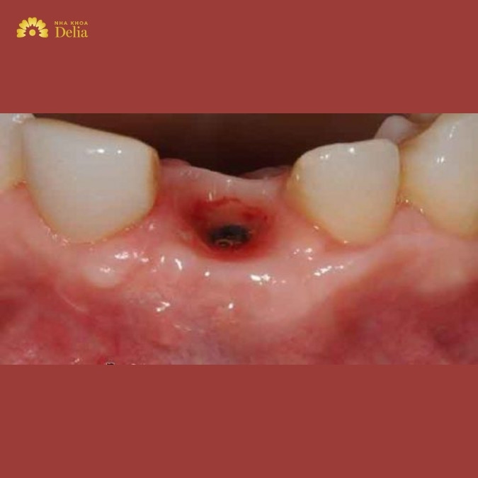 Viêm xương ổ răng thường có các dấu hiệu như thế nào? 