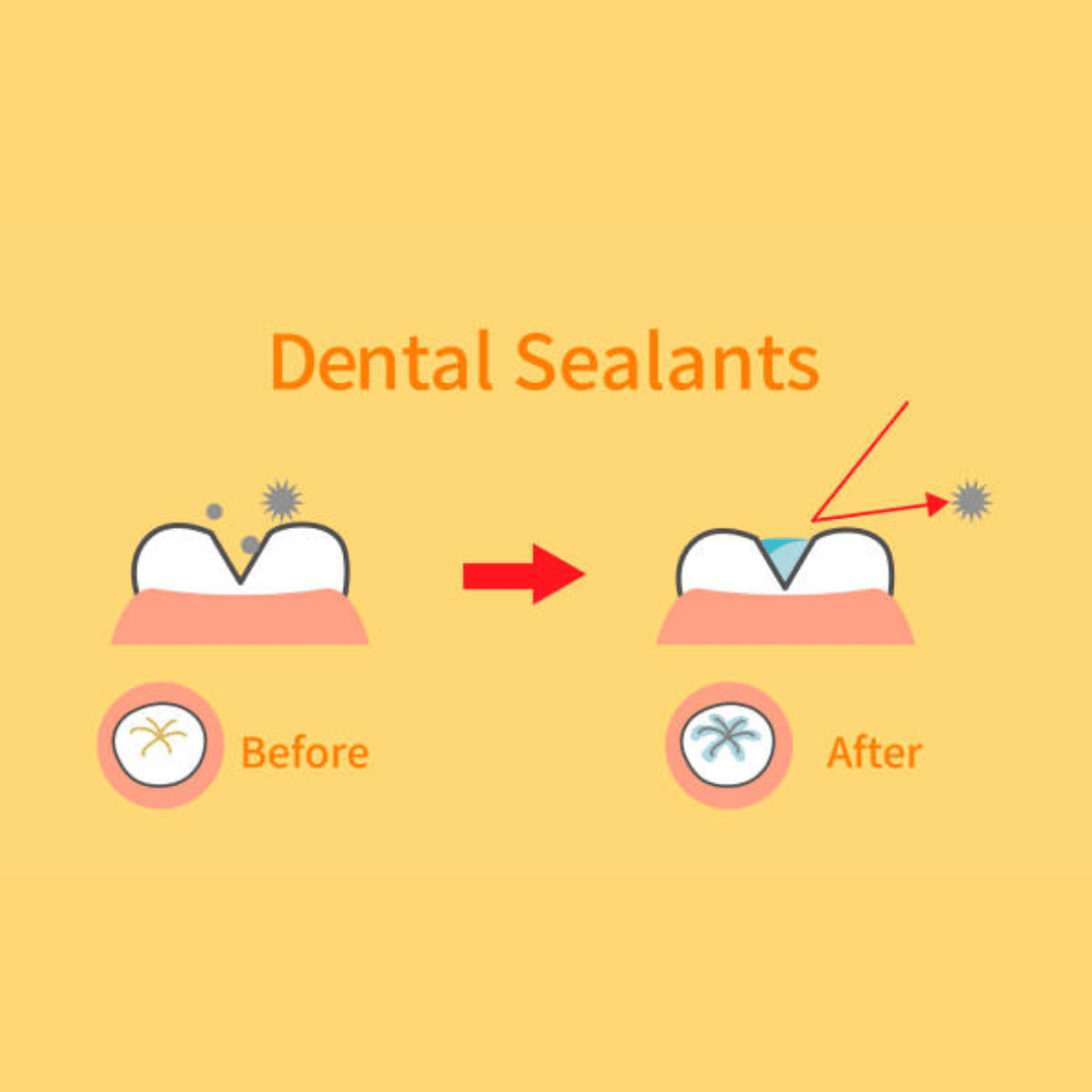 Dental Sealants