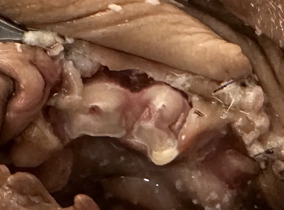 figure 3a: The appearance of the underlying mandibular first molar roots after crown amputation