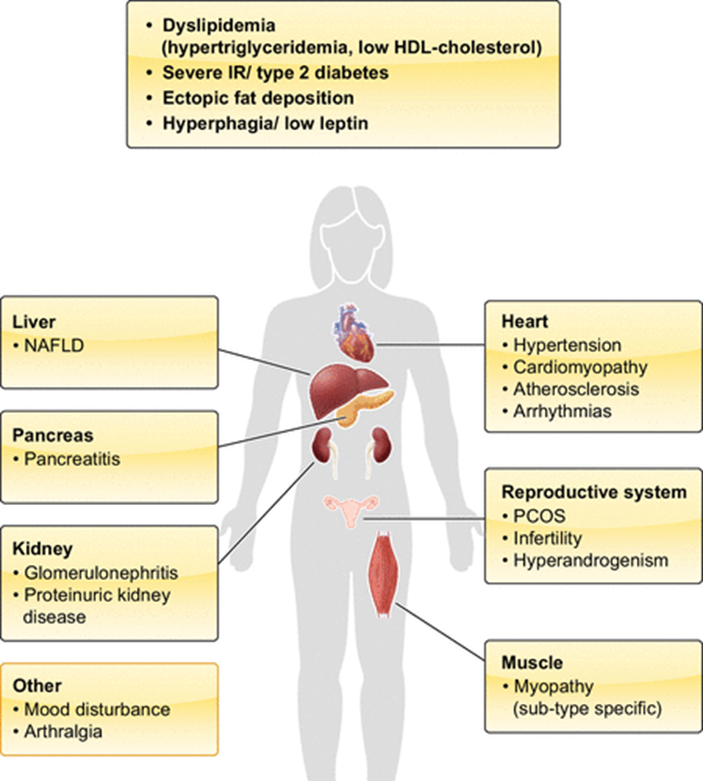 What Is Acquired Lipodystrophy - Klarity Health Library