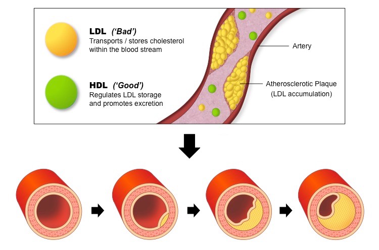 atherosclerotic plaque