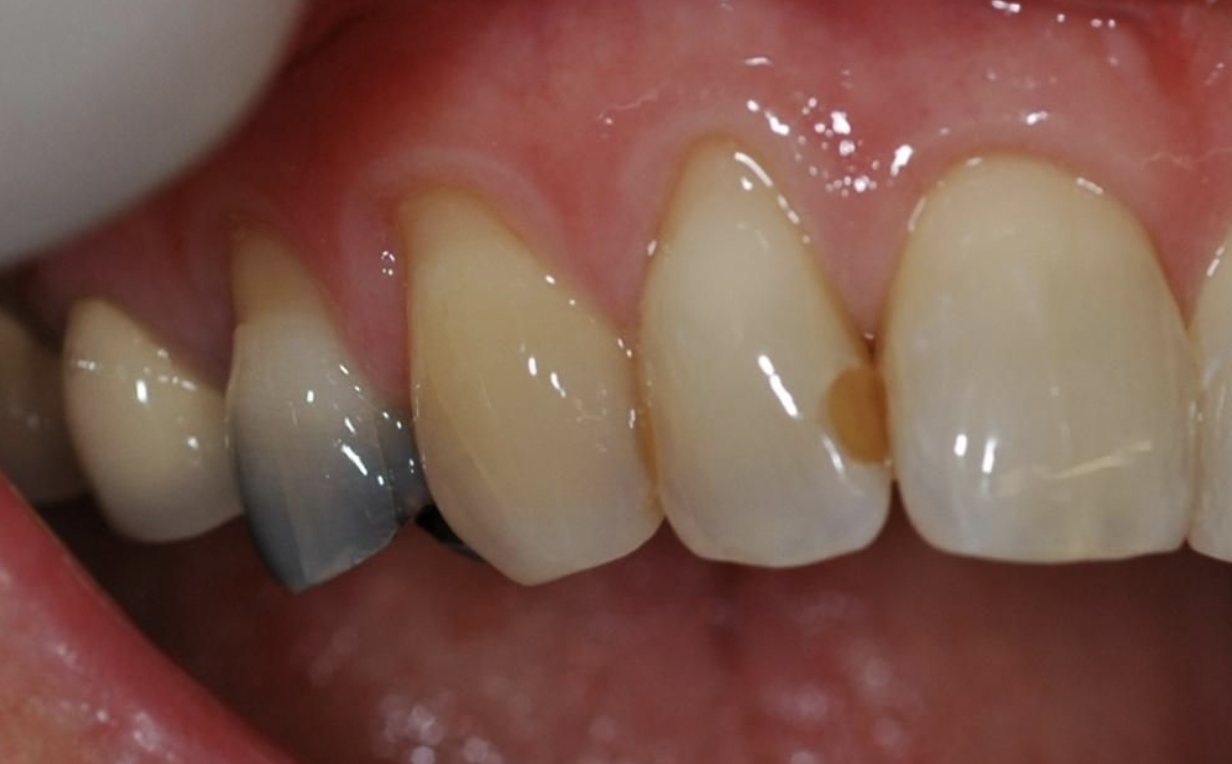 Amalgam filling shinning through 