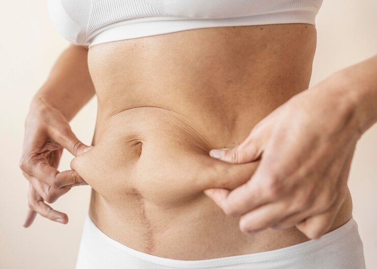 Factors to Consider Before Choosing Mommy Makeover?