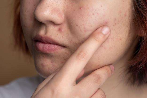 Close up on skin pores during face care routine