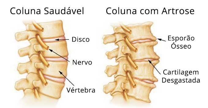 Artrose na Coluna - Coluna SP