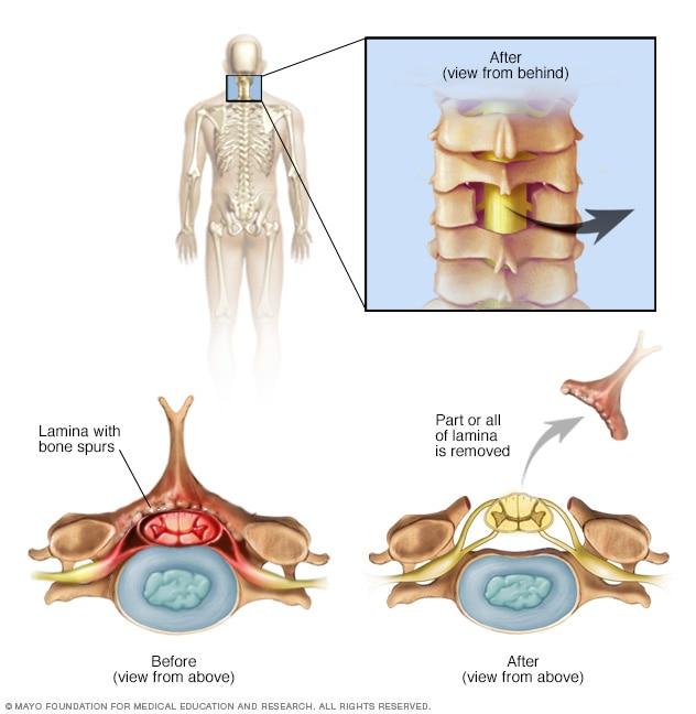 Cervical laminectomy