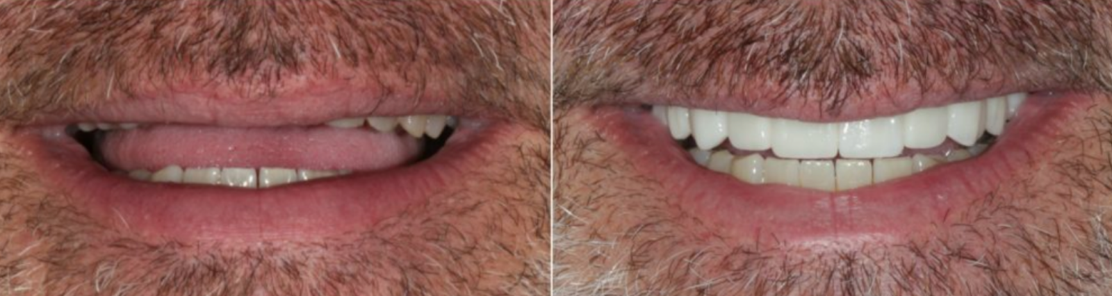 Worn teeth from a person showing less of their smile 