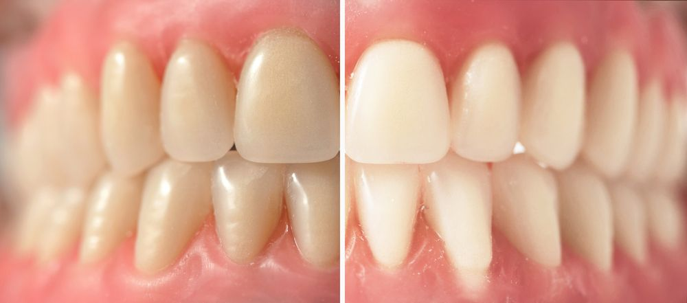 Teeth Whitening in Scarborough