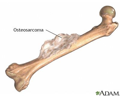 Osteosarcoma Information | Mount Sinai - New York