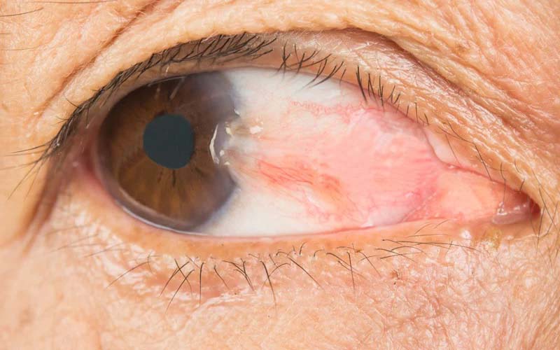 Pterygium penyebab mata mengganjal 