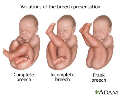 Breech - series—Types of breech presentation: MedlinePlus Medical  Encyclopedia