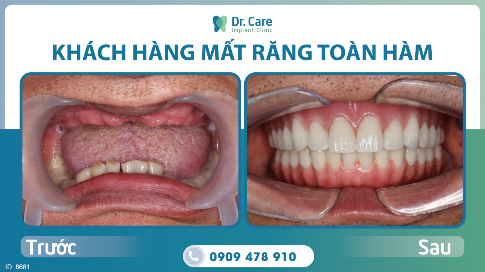 trồng răng implant mất bao lâu