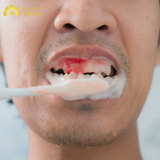 Nguyên nhân chảy máu chân răng khi đánh răng? – Cách điều trị hiệu quả nhất