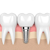 Cầu Răng Sứ và Trồng Răng Implant: Giải Pháp Cho Sức Khỏe Răng Miệng