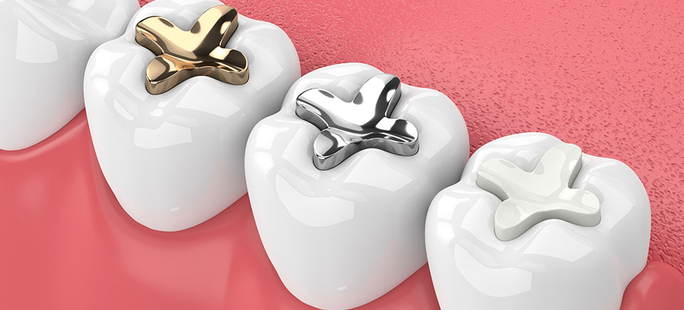 How Much is a Dental Filling Without Insurance  