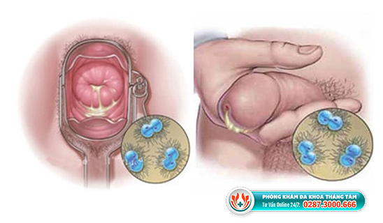 Hình ảnh bệnh lậu ở nam và nữ giới