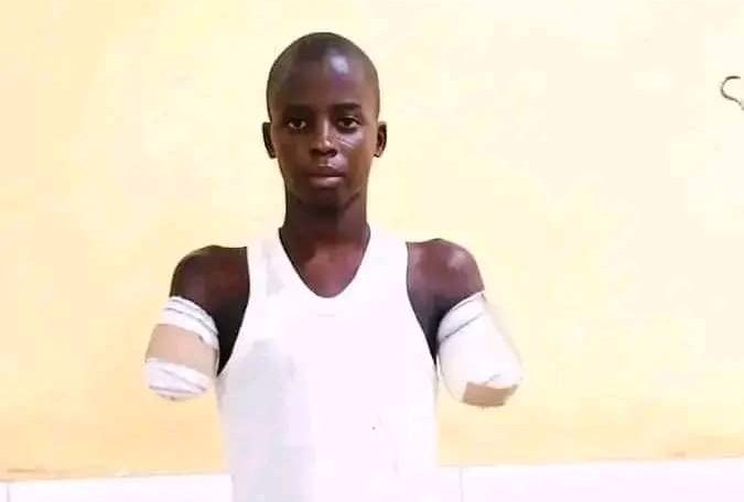 Gombe Govt to prosecute man for amputation of his 12-year-old nephew over alleged phone theft