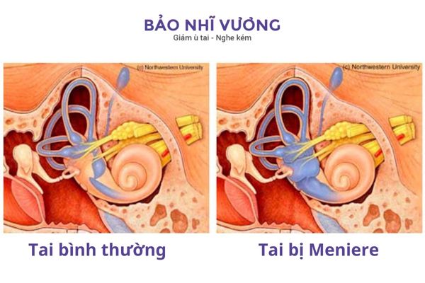 Bệnh Meniere làm tai bị ứ dịch là nguyên nhân có cảm giác tai bị nặng