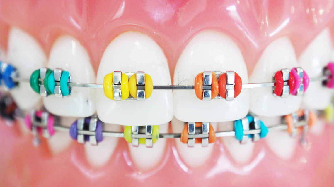 Rainbow colored braces