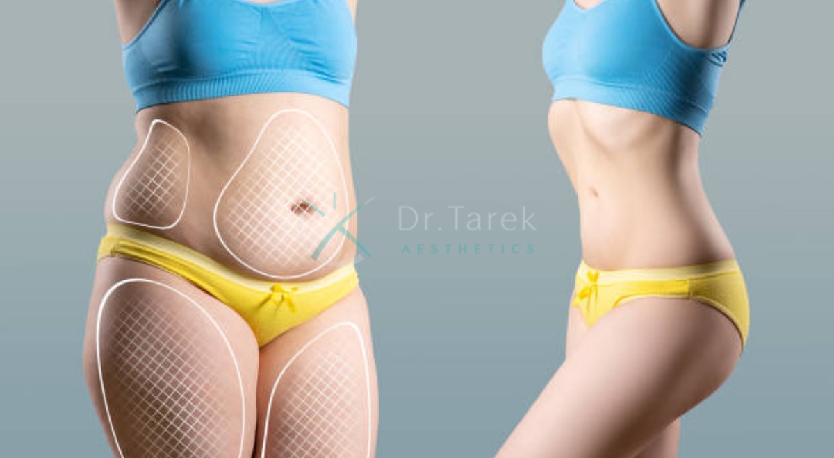 What Does Liposuction Do