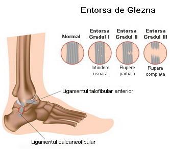 Gradele entorsei de glezna