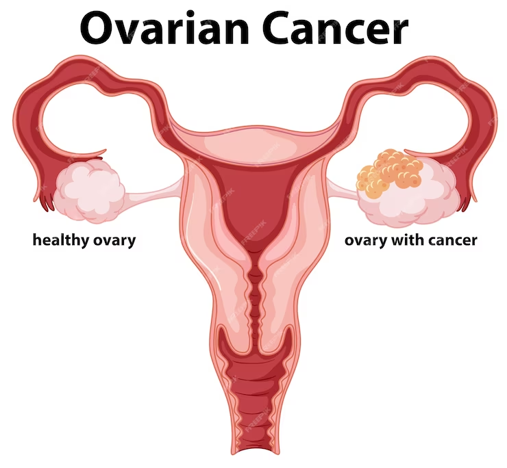 healthy ovary & ovary with cancer