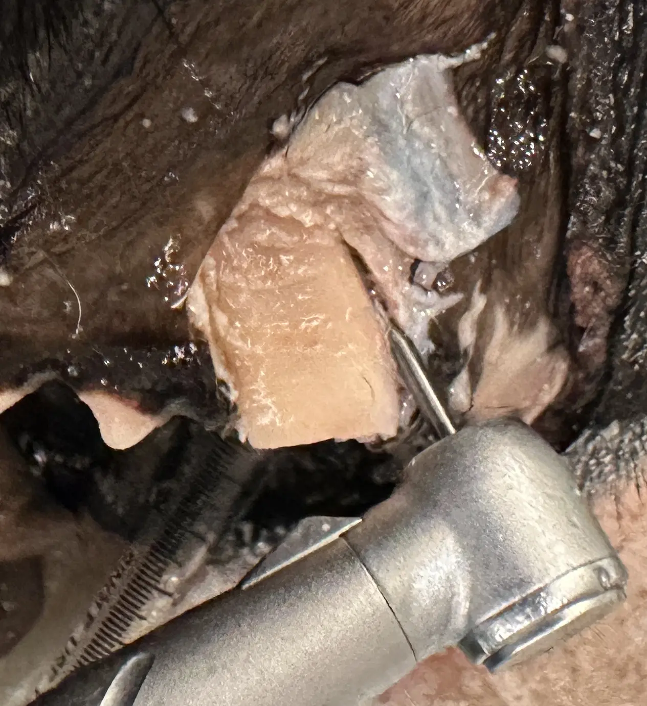 figure 4b: Crown amputation allows easy access to remove buccal bone overlying maxillary canine tooth in a cadaver specimen