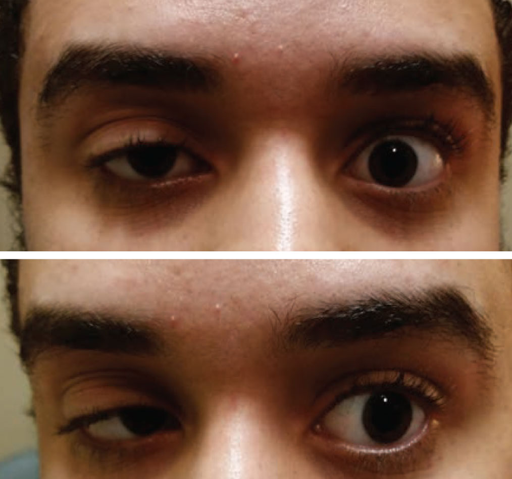 operasi mata ptosis (kelopak mata turun)