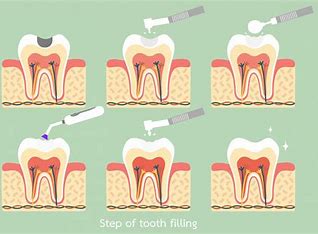 How Long Does Dental Filling Pain Last