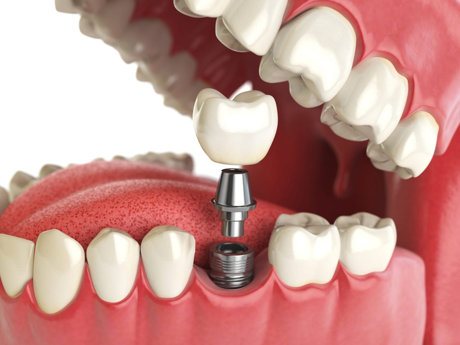dental implant surgery in Vancouver
