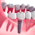 Trồng răng Implant giá bao nhiêu? Những yếu tố tác động tới chi phí trồng răng Implant