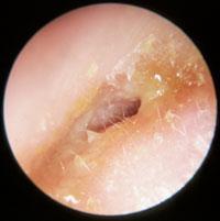 Otitis Externa