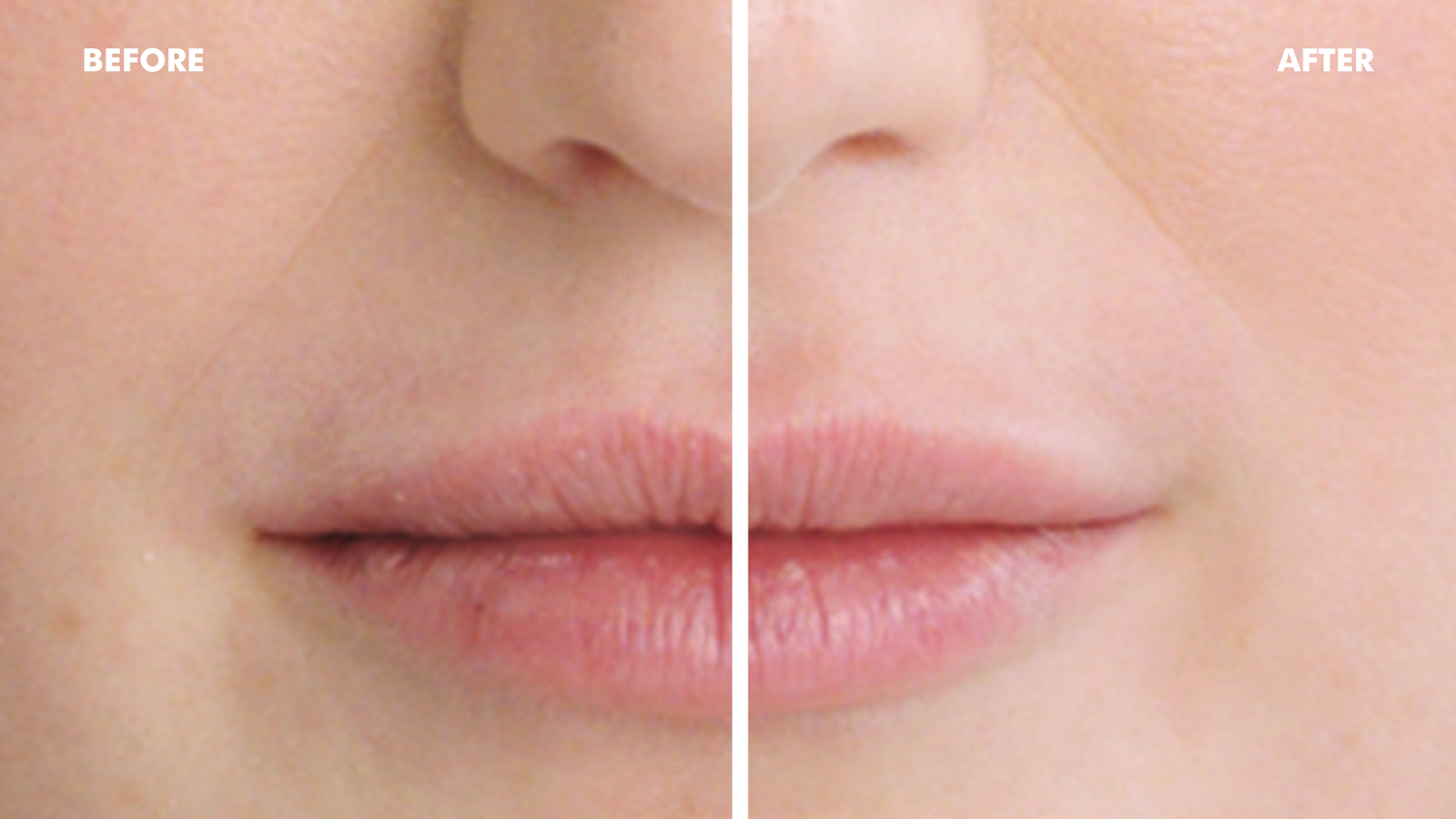 Lips before and after the treatment. 