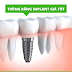 Làm răng Implant giá bao nhiêu?