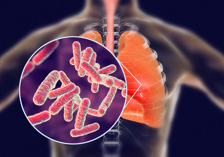 Lao phổi được xếp vào nhóm những bệnh truyền nhiễm gây ra bởi vi khuẩn lao Mycobacterium tuberculosis